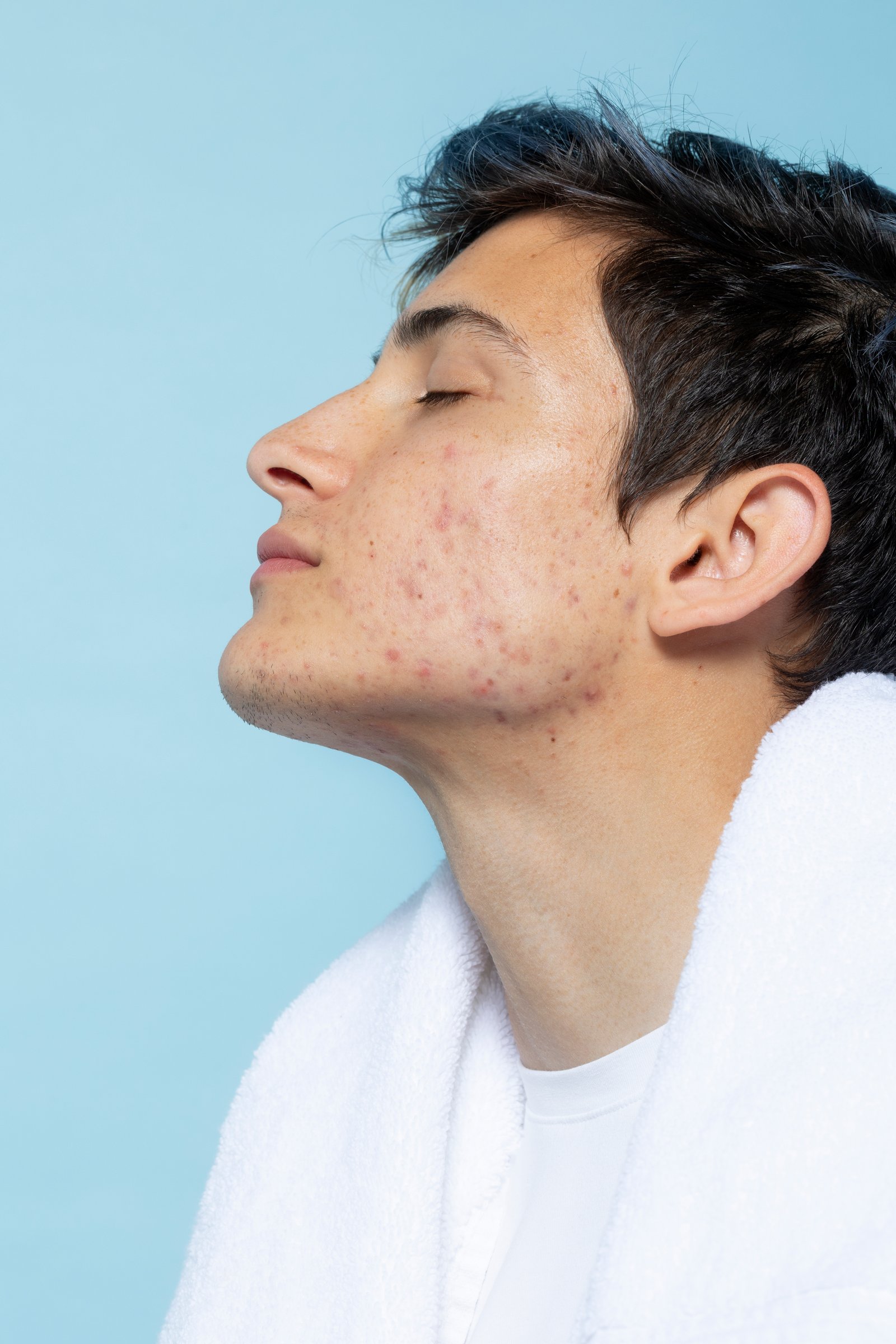 Skin care consultation for personalized acne treatment in Madurai