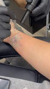 Specialist performing Q-switch laser tattoo removal at Hues Aesthetic Clinic Madurai