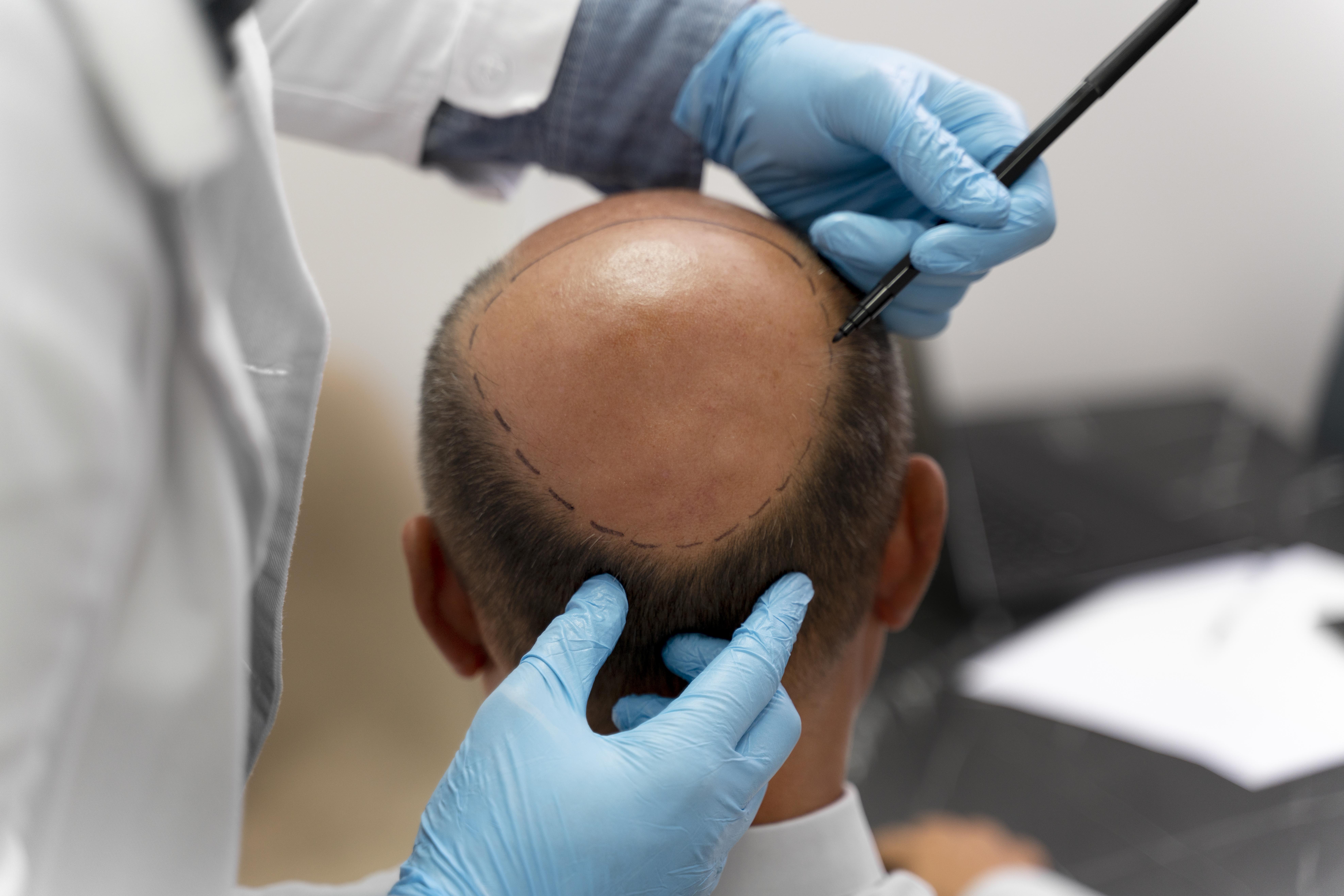 Hair Transplant in Madurai, hair clinic in Madurai, Skin Care in Madurai, Laser Treatment in Madurai, Hair Care in Madurai, hydra facial in Madurai, Hair Transplant near me, hair clinic near me, Skin Care near me, Hair Transplant in Madurai, best hair clinic in Madurai, best hydra facial in Madurai, best hair transplantation clinic in madurai, best laser unwanted hair removal in Madurai, Best Hair Restoration in Madurai, Best Hair Replacement in Madurai, Best Hair Transplant Surgery in Madurai, Best Hair Loss Treatment in Madurai, Best Hair Grafting in Madurai, Best Hair Regrowth in Madurai, Best Hair Loss Solutions in Madurai, Best Hair Transplant Clinics in Madurai, Best Baldness Treatment in Madurai, Best Hair Transplant Recovery in Madurai, Best Hair Transplant Cost in Madurai, Best Hairline Restoration in Madurai, Best Scalp Treatments in Madurai, Best Hair Thinning Solutions in Madurai, Best skin clinic in madurai, Best laser treatment in madurai, best acne scar treatment in madurai, Best chemical peels in madurai , Best laser tattoo removal clinic in madurai , Best hair fall treatment clinic in madurai , best laser skin rejuvenation clinic in madurai , Best laser scar reduction clinic in madurai, best skin brightening treatment in Madurai, Best Hair Regrowth in Madurai, Best Hair Loss Solutions in Madurai, Best Hair Transplant Clinics in Madurai, Best Baldness Treatment in Madurai, Best Hair Transplant Recovery in Madurai, Best Hair Transplant Cost in Madurai, Best Hairline Restoration in Madurai, Best Scalp Treatments in Madurai, Best Hair Thinning Solutions in Madurai, Best Hair Transplant Before and After in Madurai, Best Hair Transplant Consultation in Madurai, Laser Hair Removal in Madurai, Laser Skin Therapy in Madurai, Laser Skin Resurfacing in Madurai, Best Follicular Unit Transplantation (FUT) in Madurai, Best Follicular Unit Extraction (FUE) in Madurai, Best Scalp Micropigmentation in Madurai, Best Dark Circle Solutions in Madurai, Black Eye Treatment in Madurai, Best Beauty Therapist in Madurai, Color-Centric Skincare in Madurai, Hue-Based Skin Treatment in Madurai, Skincare for All Hues in Madurai, Skin Care for Diverse Hues in Madurai, Skin Tone-Specific Treatments in Madurai, Skincare Solutions for Every Hue in Madurai, Hue-Specific Dermatology in Madurai, Skincare by Skin Tone in Madurai, Tailored Skin Treatment for Hues in Madurai, Personalized Skincare by Hues in Madurai, Skin Care for Various Hues in Madurai, Color-Based Skin Care in Madurai, Skin Health for All Tones in Madurai, Laser Skin Tightening in Madurai, Laser Wrinkle Reduction in Madurai, Laser Scar Removal in Madurai, Laser Pigmentation Treatment in Madurai, Laser Acne Treatment in Madurai, Laser Skin Rejuvenation in Madurai, Laser Tattoo Removal in Madurai, Non-Invasive Laser Treatment in Madurai, Laser Skin Care in Madurai, Medical Laser Treatment in Madurai, Laser Dermatology in Madurai, Advanced Laser Therapy in Madurai, Cosmetic Laser Procedures in Madurai, Laser Anti-Aging in Madurai, Fractional Laser Treatment in Madurai, Laser Treatment Recovery in Madurai, Hair Treatment in Madurai, Hair Restoration in Madurai, Hair Health in Madurai, Hair Growth in Madurai, Hair Repair in Madurai, Hair Loss Prevention in Madurai, Hair Conditioning in Madurai, Hair Strengthening in Madurai, Scalp Treatment in Madurai, Hair Moisturization in Madurai, Split Ends Repair in Madurai, Natural Hair Treatments in Madurai, Hair Coloring in Madurai, Heat Damage Repair in Madurai, Hair Masks in Madurai, Organic Hair Care in Madurai, Hair Shine in Madurai, Frizz Control in Madurai, Hair Serums in Madurai.