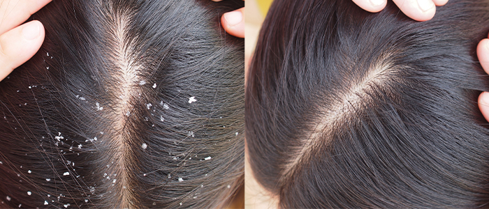 Hair Transplant in Madurai, hair clinic in Madurai, Skin Care in Madurai, Laser Treatment in Madurai, Hair Care in Madurai, hydra facial in Madurai, Hair Transplant near me, hair clinic near me, Skin Care near me, Hair Transplant in Madurai, best hair clinic in Madurai, best hydra facial in Madurai, best hair transplantation clinic in madurai, best laser unwanted hair removal in Madurai, Best Hair Restoration in Madurai, Best Hair Replacement in Madurai, Best Hair Transplant Surgery in Madurai, Best Hair Loss Treatment in Madurai, Best Hair Grafting in Madurai, Best Hair Regrowth in Madurai, Best Hair Loss Solutions in Madurai, Best Hair Transplant Clinics in Madurai, Best Baldness Treatment in Madurai, Best Hair Transplant Recovery in Madurai, Best Hair Transplant Cost in Madurai, Best Hairline Restoration in Madurai, Best Scalp Treatments in Madurai, Best Hair Thinning Solutions in Madurai, Best skin clinic in madurai, Best laser treatment in madurai, best acne scar treatment in madurai, Best chemical peels in madurai , Best laser tattoo removal clinic in madurai , Best hair fall treatment clinic in madurai , best laser skin rejuvenation clinic in madurai , Best laser scar reduction clinic in madurai, best skin brightening treatment in Madurai, Best Hair Regrowth in Madurai, Best Hair Loss Solutions in Madurai, Best Hair Transplant Clinics in Madurai, Best Baldness Treatment in Madurai, Best Hair Transplant Recovery in Madurai, Best Hair Transplant Cost in Madurai, Best Hairline Restoration in Madurai, Best Scalp Treatments in Madurai, Best Hair Thinning Solutions in Madurai, Best Hair Transplant Before and After in Madurai, Best Hair Transplant Consultation in Madurai, Laser Hair Removal in Madurai, Laser Skin Therapy in Madurai, Laser Skin Resurfacing in Madurai, Best Follicular Unit Transplantation (FUT) in Madurai, Best Follicular Unit Extraction (FUE) in Madurai, Best Scalp Micropigmentation in Madurai, Best Dark Circle Solutions in Madurai, Black Eye Treatment in Madurai, Best Beauty Therapist in Madurai, Color-Centric Skincare in Madurai, Hue-Based Skin Treatment in Madurai, Skincare for All Hues in Madurai, Skin Care for Diverse Hues in Madurai, Skin Tone-Specific Treatments in Madurai, Skincare Solutions for Every Hue in Madurai, Hue-Specific Dermatology in Madurai, Skincare by Skin Tone in Madurai, Tailored Skin Treatment for Hues in Madurai, Personalized Skincare by Hues in Madurai, Skin Care for Various Hues in Madurai, Color-Based Skin Care in Madurai, Skin Health for All Tones in Madurai, Laser Skin Tightening in Madurai, Laser Wrinkle Reduction in Madurai, Laser Scar Removal in Madurai, Laser Pigmentation Treatment in Madurai, Laser Acne Treatment in Madurai, Laser Skin Rejuvenation in Madurai, Laser Tattoo Removal in Madurai, Non-Invasive Laser Treatment in Madurai, Laser Skin Care in Madurai, Medical Laser Treatment in Madurai, Laser Dermatology in Madurai, Advanced Laser Therapy in Madurai, Cosmetic Laser Procedures in Madurai, Laser Anti-Aging in Madurai, Fractional Laser Treatment in Madurai, Laser Treatment Recovery in Madurai, Hair Treatment in Madurai, Hair Restoration in Madurai, Hair Health in Madurai, Hair Growth in Madurai, Hair Repair in Madurai, Hair Loss Prevention in Madurai, Hair Conditioning in Madurai, Hair Strengthening in Madurai, Scalp Treatment in Madurai, Hair Moisturization in Madurai, Split Ends Repair in Madurai, Natural Hair Treatments in Madurai, Hair Coloring in Madurai, Heat Damage Repair in Madurai, Hair Masks in Madurai, Organic Hair Care in Madurai, Hair Shine in Madurai, Frizz Control in Madurai, Hair Serums in Madurai.