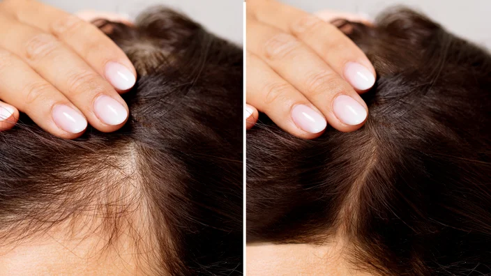 Hair Transplant in Madurai, hair clinic in Madurai, Skin Care in Madurai, Laser Treatment in Madurai, Hair Care in Madurai, hydra facial in Madurai, Hair Transplant near me, hair clinic near me, Skin Care near me, Hair Transplant in Madurai, best hair clinic in Madurai, best hydra facial in Madurai, best hair transplantation clinic in madurai, best laser unwanted hair removal in Madurai, Best Hair Restoration in Madurai, Best Hair Replacement in Madurai, Best Hair Transplant Surgery in Madurai, Best Hair Loss Treatment in Madurai, Best Hair Grafting in Madurai, Best Hair Regrowth in Madurai, Best Hair Loss Solutions in Madurai, Best Hair Transplant Clinics in Madurai, Best Baldness Treatment in Madurai, Best Hair Transplant Recovery in Madurai, Best Hair Transplant Cost in Madurai, Best Hairline Restoration in Madurai, Best Scalp Treatments in Madurai, Best Hair Thinning Solutions in Madurai, Best skin clinic in madurai, Best laser treatment in madurai, best acne scar treatment in madurai, Best chemical peels in madurai , Best laser tattoo removal clinic in madurai , Best hair fall treatment clinic in madurai , best laser skin rejuvenation clinic in madurai , Best laser scar reduction clinic in madurai, best skin brightening treatment in Madurai, Best Hair Regrowth in Madurai, Best Hair Loss Solutions in Madurai, Best Hair Transplant Clinics in Madurai, Best Baldness Treatment in Madurai, Best Hair Transplant Recovery in Madurai, Best Hair Transplant Cost in Madurai, Best Hairline Restoration in Madurai, Best Scalp Treatments in Madurai, Best Hair Thinning Solutions in Madurai, Best Hair Transplant Before and After in Madurai, Best Hair Transplant Consultation in Madurai, Laser Hair Removal in Madurai, Laser Skin Therapy in Madurai, Laser Skin Resurfacing in Madurai, Best Follicular Unit Transplantation (FUT) in Madurai, Best Follicular Unit Extraction (FUE) in Madurai, Best Scalp Micropigmentation in Madurai, Best Dark Circle Solutions in Madurai, Black Eye Treatment in Madurai, Best Beauty Therapist in Madurai, Color-Centric Skincare in Madurai, Hue-Based Skin Treatment in Madurai, Skincare for All Hues in Madurai, Skin Care for Diverse Hues in Madurai, Skin Tone-Specific Treatments in Madurai, Skincare Solutions for Every Hue in Madurai, Hue-Specific Dermatology in Madurai, Skincare by Skin Tone in Madurai, Tailored Skin Treatment for Hues in Madurai, Personalized Skincare by Hues in Madurai, Skin Care for Various Hues in Madurai, Color-Based Skin Care in Madurai, Skin Health for All Tones in Madurai, Laser Skin Tightening in Madurai, Laser Wrinkle Reduction in Madurai, Laser Scar Removal in Madurai, Laser Pigmentation Treatment in Madurai, Laser Acne Treatment in Madurai, Laser Skin Rejuvenation in Madurai, Laser Tattoo Removal in Madurai, Non-Invasive Laser Treatment in Madurai, Laser Skin Care in Madurai, Medical Laser Treatment in Madurai, Laser Dermatology in Madurai, Advanced Laser Therapy in Madurai, Cosmetic Laser Procedures in Madurai, Laser Anti-Aging in Madurai, Fractional Laser Treatment in Madurai, Laser Treatment Recovery in Madurai, Hair Treatment in Madurai, Hair Restoration in Madurai, Hair Health in Madurai, Hair Growth in Madurai, Hair Repair in Madurai, Hair Loss Prevention in Madurai, Hair Conditioning in Madurai, Hair Strengthening in Madurai, Scalp Treatment in Madurai, Hair Moisturization in Madurai, Split Ends Repair in Madurai, Natural Hair Treatments in Madurai, Hair Coloring in Madurai, Heat Damage Repair in Madurai, Hair Masks in Madurai, Organic Hair Care in Madurai, Hair Shine in Madurai, Frizz Control in Madurai, Hair Serums in Madurai.