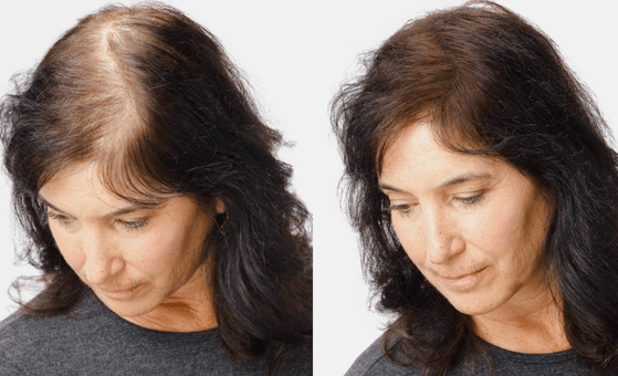 Hair Transplant in Madurai, hair clinic in Madurai, Skin Care in Madurai, Laser Treatment in Madurai, Hair Care in Madurai, hydra facial in Madurai, Hair Transplant near me, hair clinic near me, Skin Care near me, Hair Transplant in Madurai, best hair clinic in Madurai, best hydra facial in Madurai, best hair transplantation clinic in madurai, best laser unwanted hair removal in Madurai, Best Hair Restoration in Madurai, Best Hair Replacement in Madurai, Best Hair Transplant Surgery in Madurai, Best Hair Loss Treatment in Madurai, Best Hair Grafting in Madurai, Best Hair Regrowth in Madurai, Best Hair Loss Solutions in Madurai, Best Hair Transplant Clinics in Madurai, Best Baldness Treatment in Madurai, Best Hair Transplant Recovery in Madurai, Best Hair Transplant Cost in Madurai, Best Hairline Restoration in Madurai, Best Scalp Treatments in Madurai, Best Hair Thinning Solutions in Madurai, Best skin clinic in madurai, Best laser treatment in madurai, best acne scar treatment in madurai, Best chemical peels in madurai , Best laser tattoo removal clinic in madurai , Best hair fall treatment clinic in madurai , best laser skin rejuvenation clinic in madurai , Best laser scar reduction clinic in madurai, best skin brightening treatment in Madurai, Best Hair Regrowth in Madurai, Best Hair Loss Solutions in Madurai, Best Hair Transplant Clinics in Madurai, Best Baldness Treatment in Madurai, Best Hair Transplant Recovery in Madurai, Best Hair Transplant Cost in Madurai, Best Hairline Restoration in Madurai, Best Scalp Treatments in Madurai, Best Hair Thinning Solutions in Madurai, Best Hair Transplant Before and After in Madurai, Best Hair Transplant Consultation in Madurai, Laser Hair Removal in Madurai, Laser Skin Therapy in Madurai, Laser Skin Resurfacing in Madurai, Best Follicular Unit Transplantation (FUT) in Madurai, Best Follicular Unit Extraction (FUE) in Madurai, Best Scalp Micropigmentation in Madurai, Best Dark Circle Solutions in Madurai, Black Eye Treatment in Madurai, Best Beauty Therapist in Madurai, Color-Centric Skincare in Madurai, Hue-Based Skin Treatment in Madurai, Skincare for All Hues in Madurai, Skin Care for Diverse Hues in Madurai, Skin Tone-Specific Treatments in Madurai, Skincare Solutions for Every Hue in Madurai, Hue-Specific Dermatology in Madurai, Skincare by Skin Tone in Madurai, Tailored Skin Treatment for Hues in Madurai, Personalized Skincare by Hues in Madurai, Skin Care for Various Hues in Madurai, Color-Based Skin Care in Madurai, Skin Health for All Tones in Madurai, Laser Skin Tightening in Madurai, Laser Wrinkle Reduction in Madurai, Laser Scar Removal in Madurai, Laser Pigmentation Treatment in Madurai, Laser Acne Treatment in Madurai, Laser Skin Rejuvenation in Madurai, Laser Tattoo Removal in Madurai, Non-Invasive Laser Treatment in Madurai, Laser Skin Care in Madurai, Medical Laser Treatment in Madurai, Laser Dermatology in Madurai, Advanced Laser Therapy in Madurai, Cosmetic Laser Procedures in Madurai, Laser Anti-Aging in Madurai, Fractional Laser Treatment in Madurai, Laser Treatment Recovery in Madurai, Hair Treatment in Madurai, Hair Restoration in Madurai, Hair Health in Madurai, Hair Growth in Madurai, Hair Repair in Madurai, Hair Loss Prevention in Madurai, Hair Conditioning in Madurai, Hair Strengthening in Madurai, Scalp Treatment in Madurai, Hair Moisturization in Madurai, Split Ends Repair in Madurai, Natural Hair Treatments in Madurai, Hair Coloring in Madurai, Heat Damage Repair in Madurai, Hair Masks in Madurai, Organic Hair Care in Madurai, Hair Shine in Madurai, Frizz Control in Madurai, Hair Serums in Madurai.