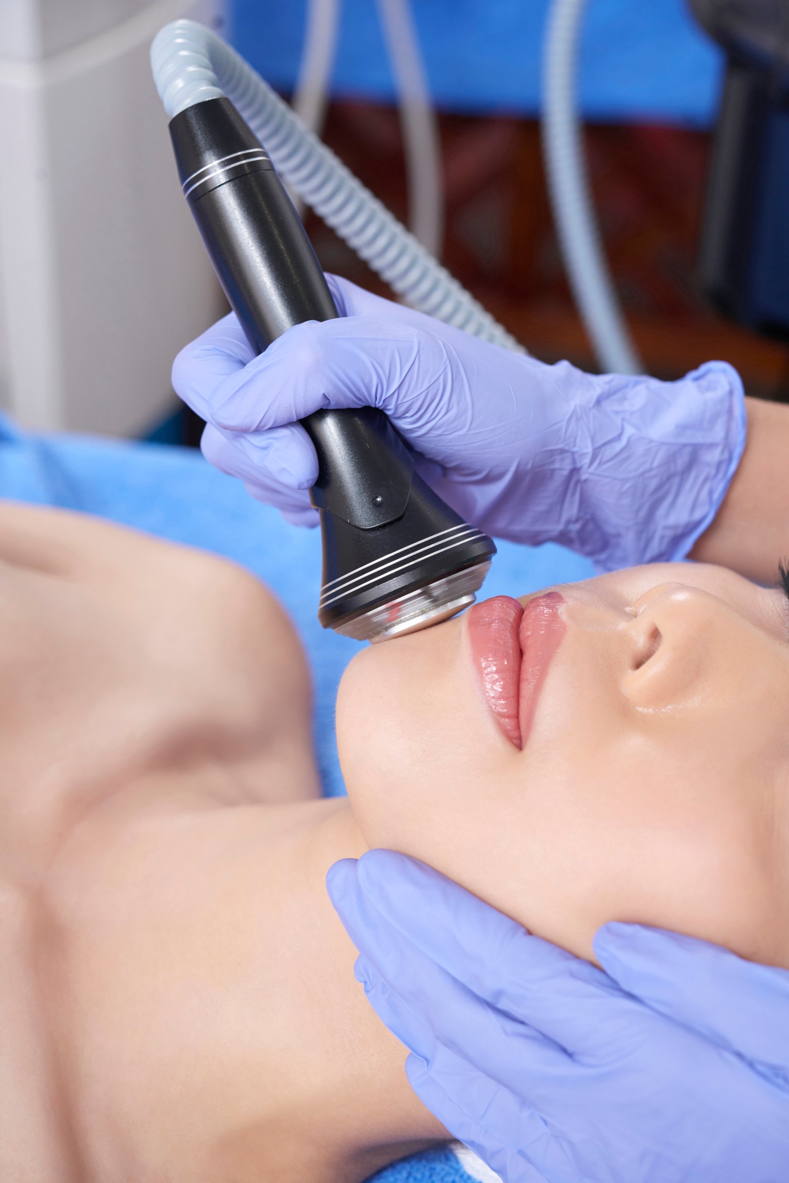 Specialist performing advanced fractional laser scar reduction at Hues Aesthetic Clinic Madurai