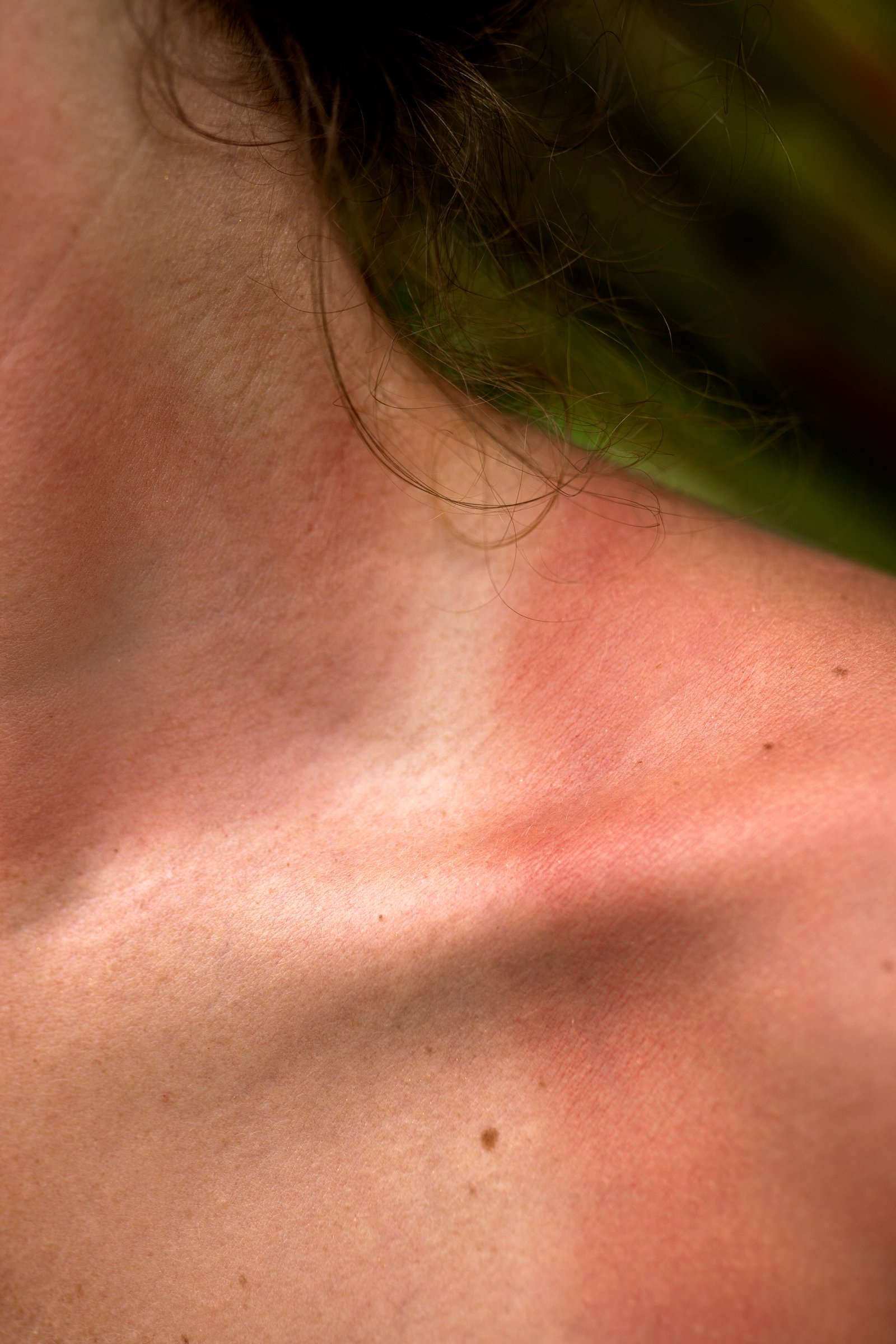 Skin care consultation for personalized acne treatment in Madurai