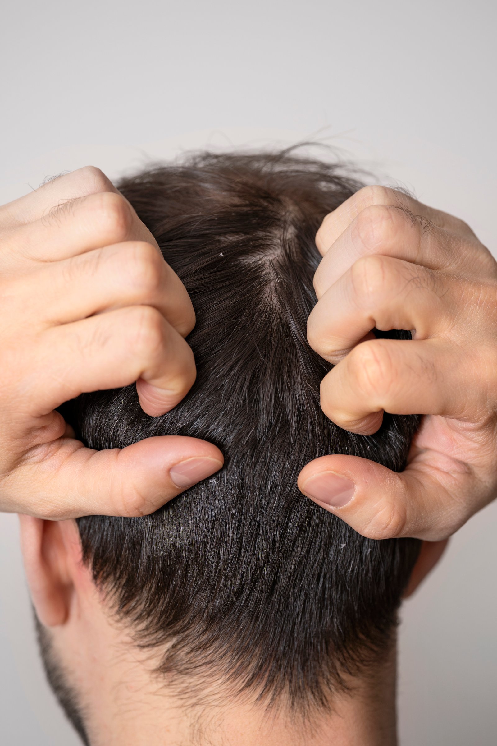 Specialist performing scientific anti-dandruff scalp treatment at Hues Aesthetic Clinic Madurai