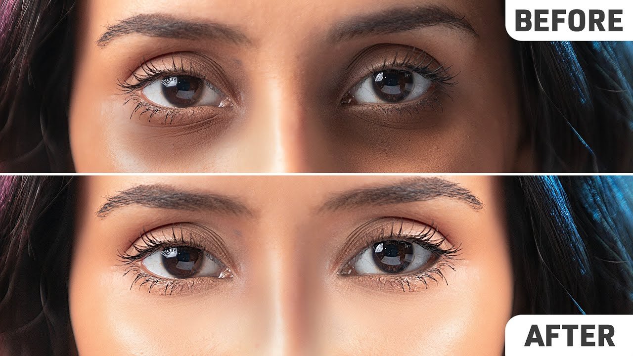 Doctor performing advanced under eye dark circle treatment at Hues Aesthetic Clinic Madurai