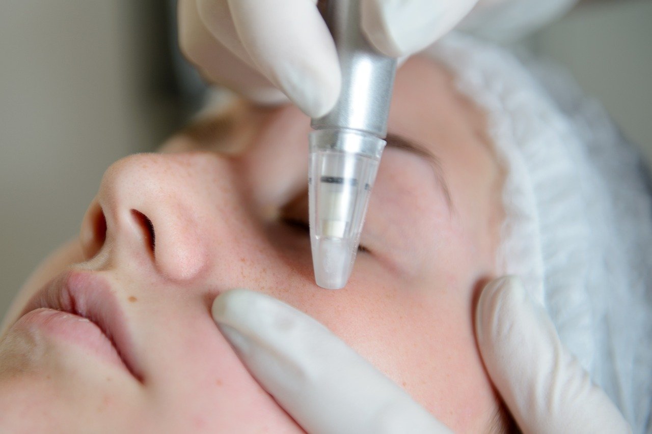 Specialist performing diamond-tip microdermabrasion skin exfoliation treatment at Hues Aesthetic Clinic Madurai