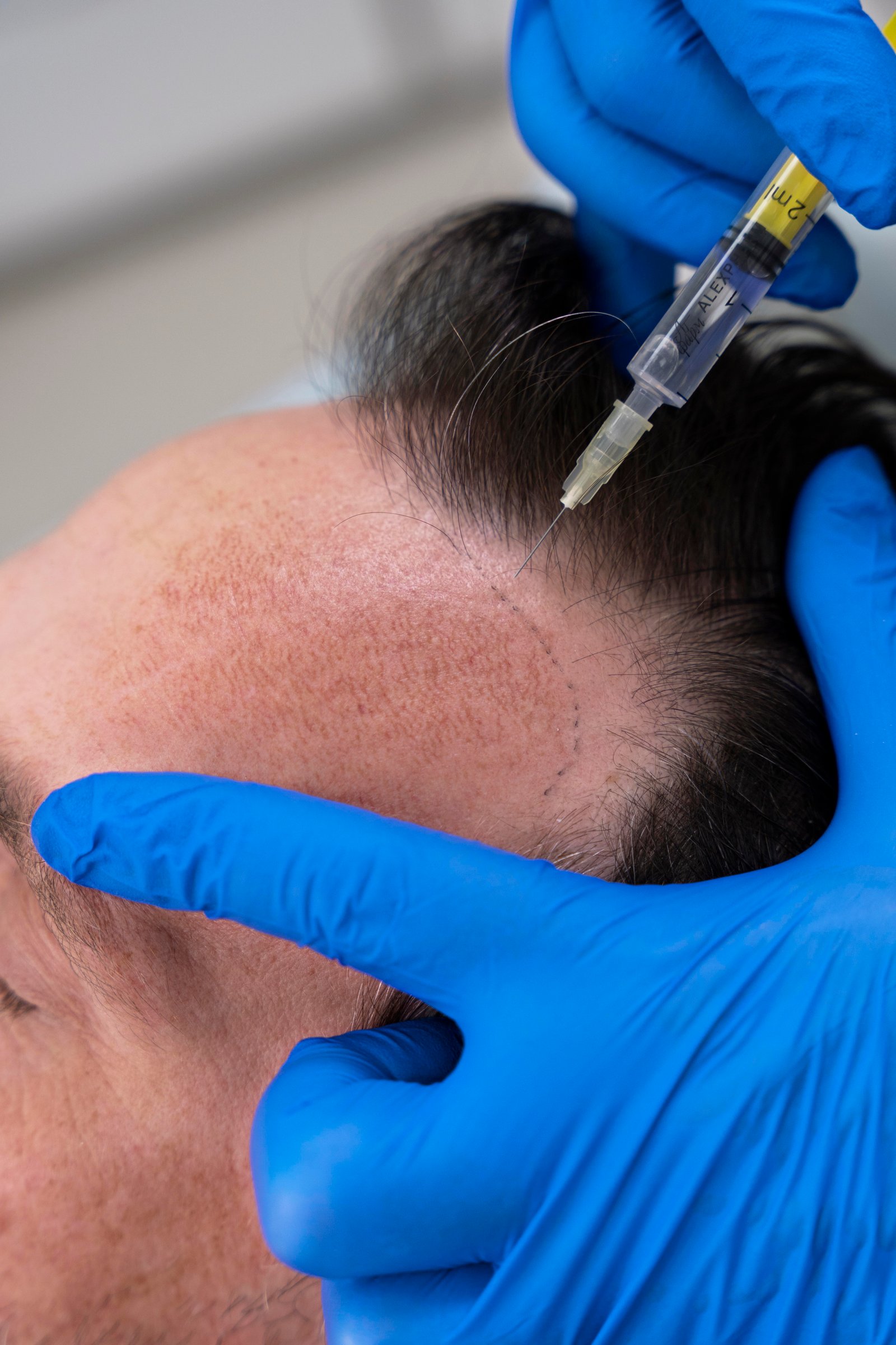 Specialist performing precise scalp micropigmentation SMP procedure at Hues Aesthetic Clinic Madurai
