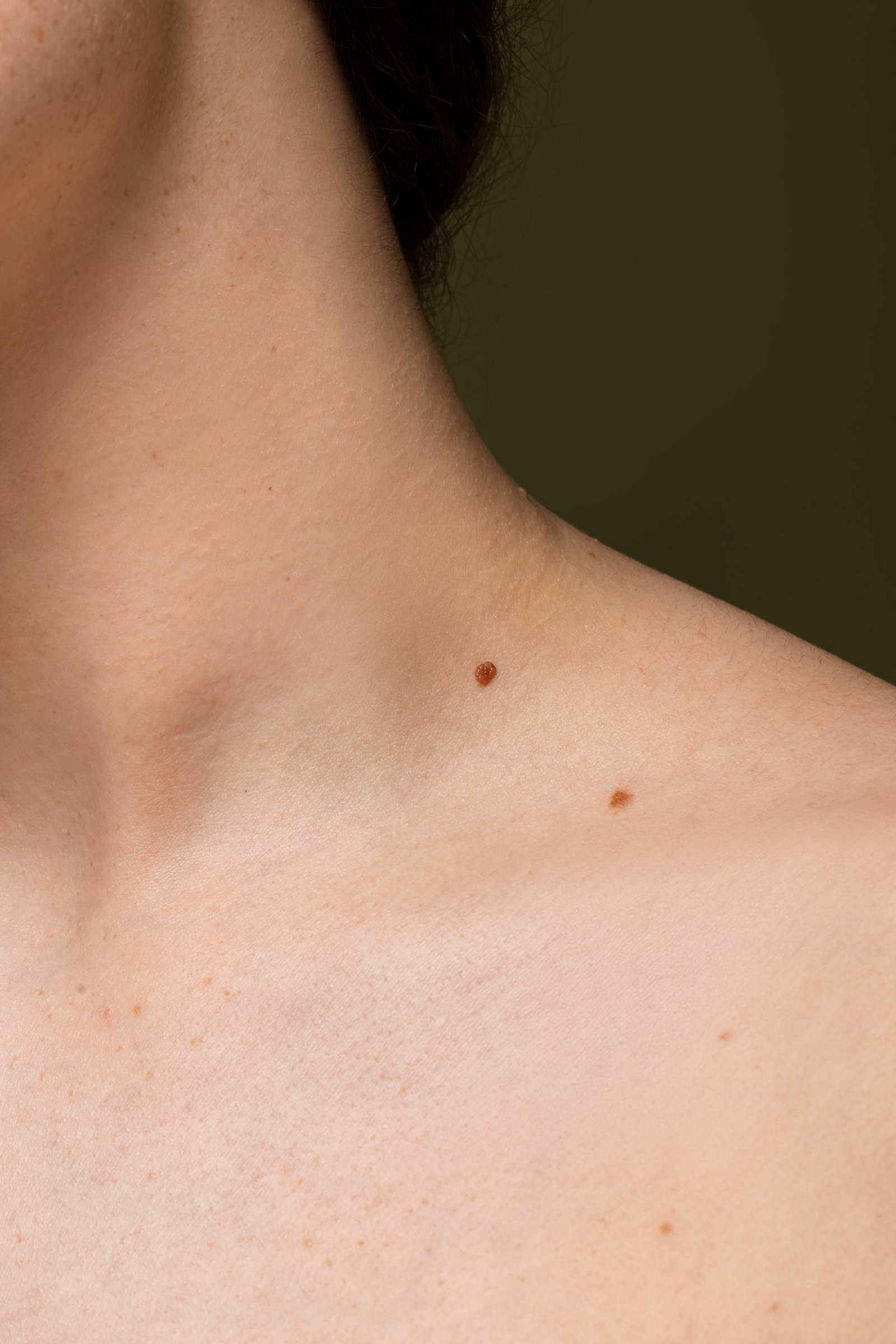 Specialist performing laser wart removal treatment at Hues Aesthetic Clinic Madurai