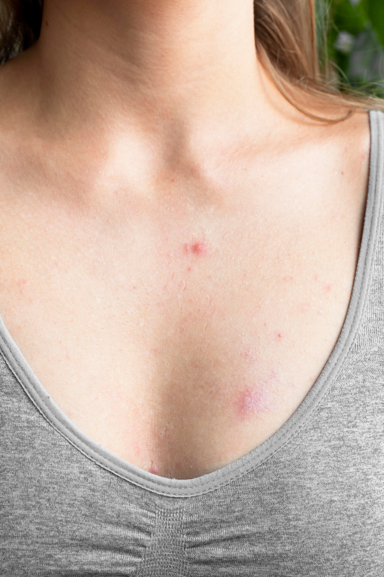 Specialist performing laser wart removal treatment at Hues Aesthetic Clinic Madurai