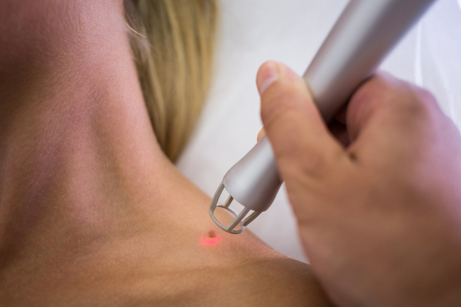 Specialist performing laser wart removal treatment at Hues Aesthetic Clinic Madurai