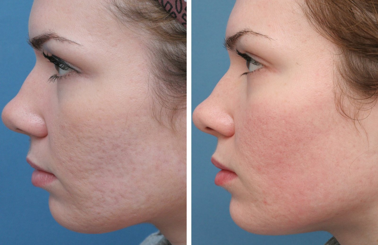Acne scar treatment before and after results at Hues Madurai